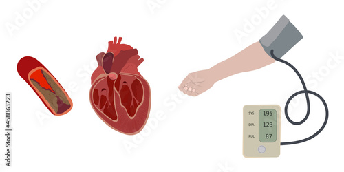 A hand and a tonometer with hypertension, high blood pressure. Atherosclerosis causes enlarged heart. Flat vector medical illustration.