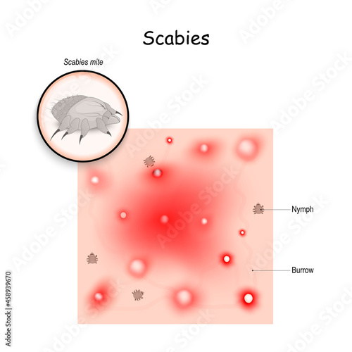 Scabies. contagious skin infestation