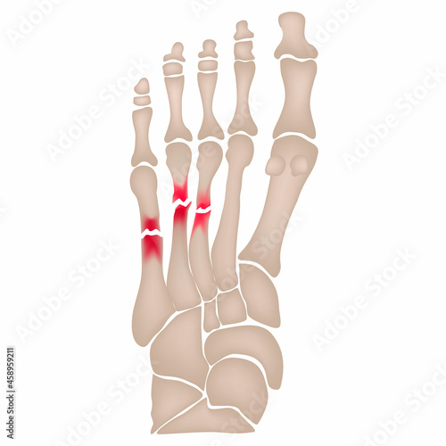 Fracture of the metatarsal bones in the foot. Anatomical structure of the foot. Skeleton. Broken bones. Vector illustration on isolated background photo