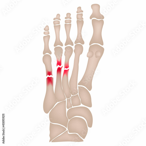Fracture of the metatarsal bones in the foot. Anatomical structure of the foot. Skeleton. Broken bones. Vector illustration on isolated background