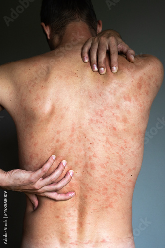Allergy concept. Man suffers from skin irritation isolated on gray background. Itchy back with rash