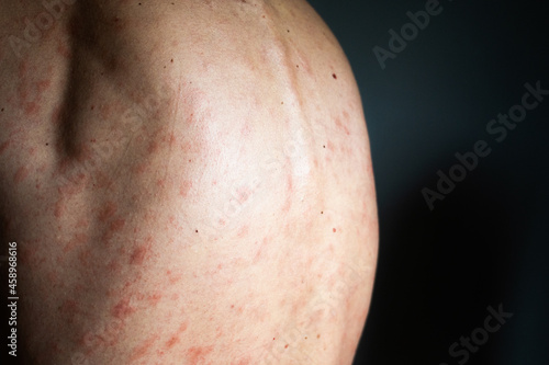 Allergy concept. Man suffers from skin irritation isolated on gray background. Itchy back with rash