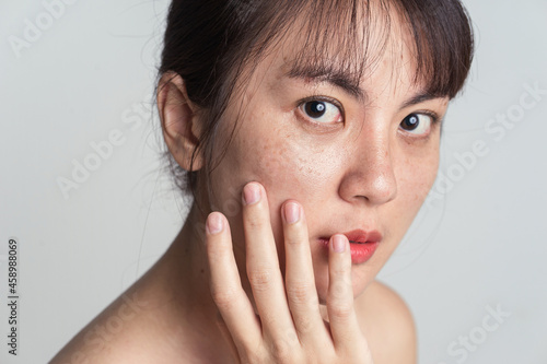 Canvas Print Young Asian woman worry with freckle on face.