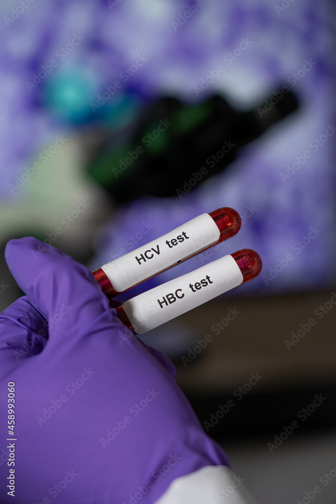 Obraz premium Blood tests for hepatitis b (HBC) and c (HCV).