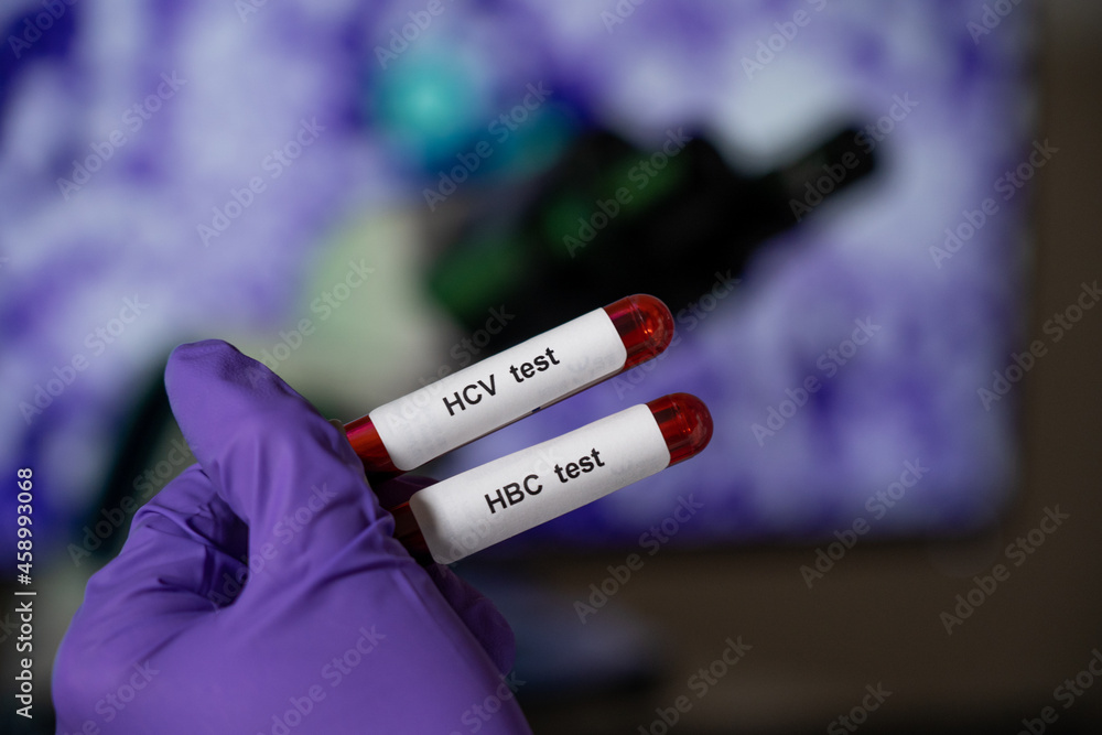 Obraz premium Blood tests for hepatitis b (HBC) and c (HCV).