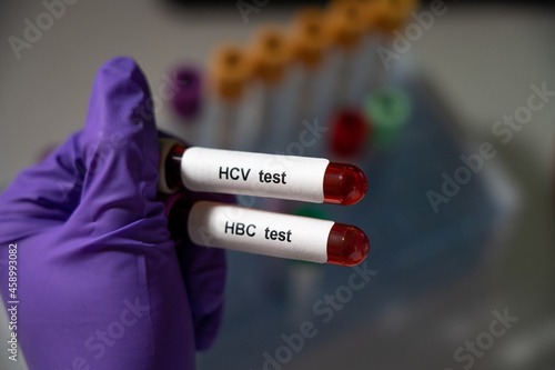 Blood tests for hepatitis b (HBC) and c (HCV). photo