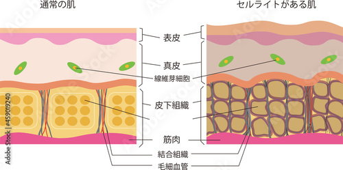 通常の肌断面図セルライト状態の肌断面図イラスト