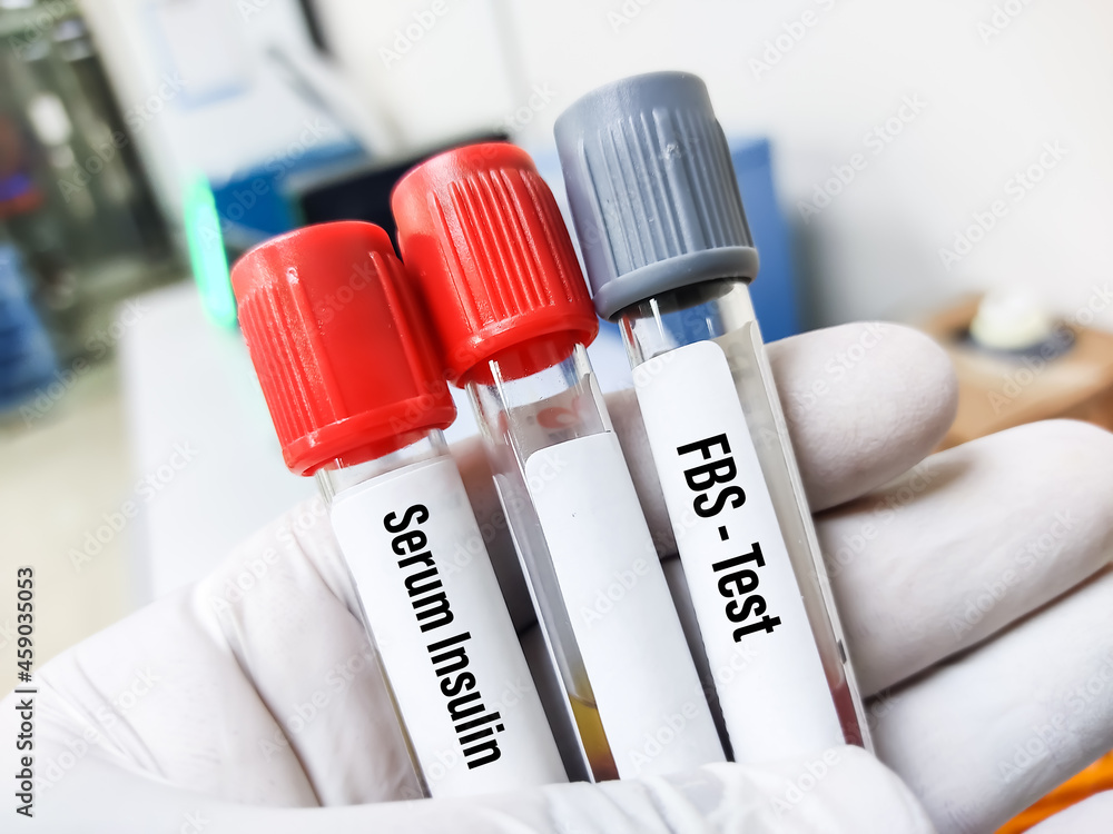 Scientist holds blood sample for Fasting Blood Sugar and Serum Insulin test, FBS, diagnosis for hyperglycemia or hypoglycemia in Diabetes Mellitus (DM).Medical testing concept, laboratory background