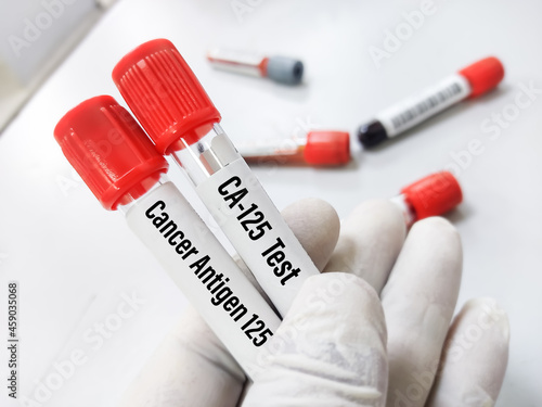 Blood sample for CA 19.9 test, diagnosis of pancreatic cancer