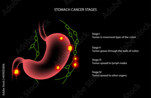 Stomach cancer anatomy