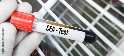 Blood sample for CEA(carcinoembryonic antigen) test, tumor marker for colorectal cancer photo
