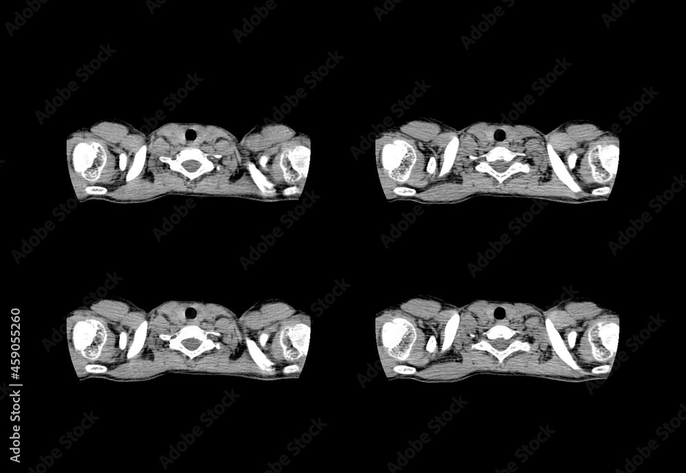 Ct scan and MRI chest unique professional images Ct scan and MRI chest unique professional images