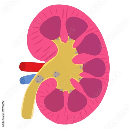 Vector illustration of a kidney with a kidney stone condition, suitable for advertising health and education products