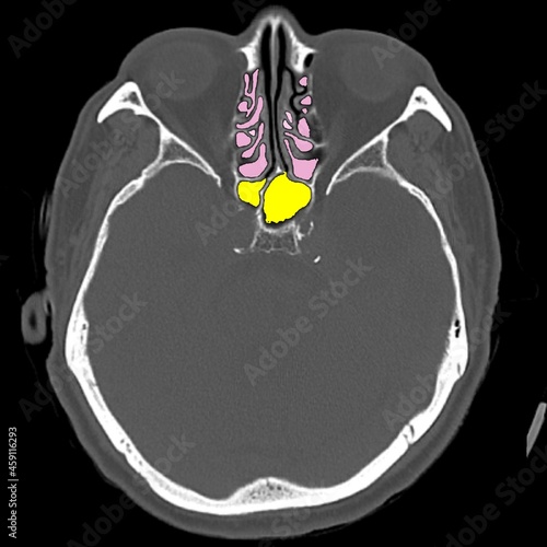 Ct scan of paranasal sinus showing sphenoidalis and ethmoidalis sinus photo