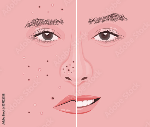 The face of a woman with acne and not acne obviously different.