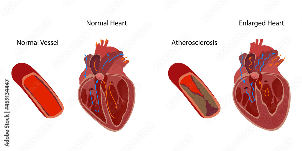Normal and enlarged heart, cardiomegaly, atherosclerosis. Direction of