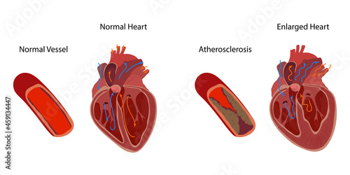 Normal and enlarged heart, cardiomegaly, atherosclerosis. Direction of blood flow. Inner inside view. Vector anatomy flat medical illustration.
