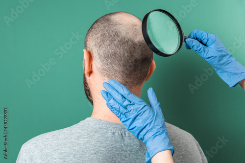 Canvas Print Trichologist examines the area of baldness on the client's head with a magnifying glass
