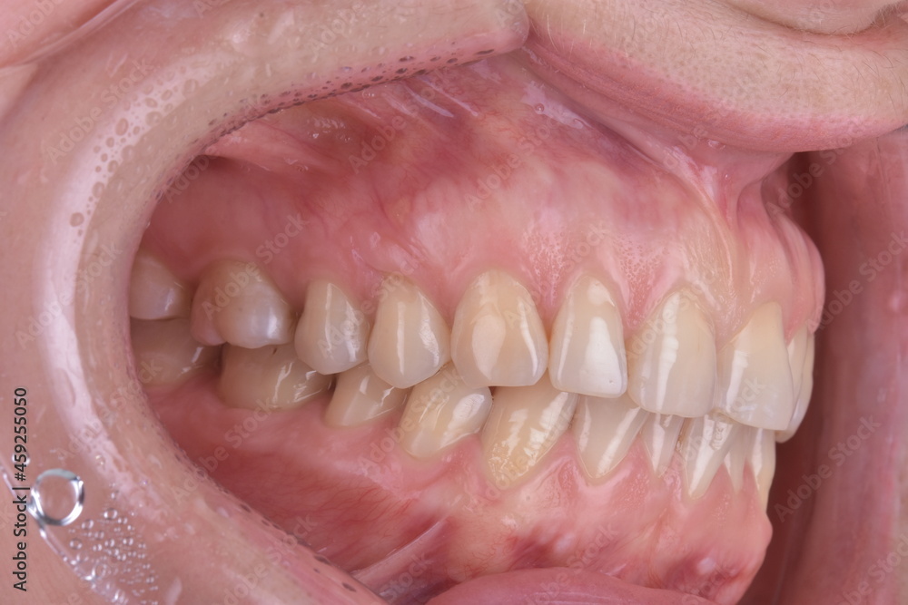 Obraz premium Tooth In-oral Photo