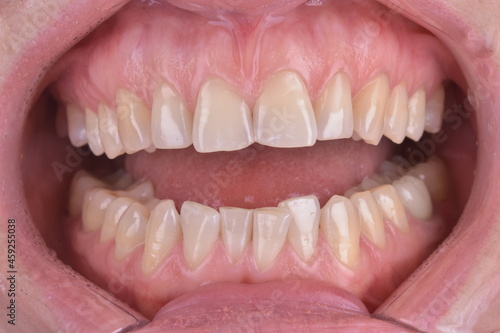 close up of mouth with braces