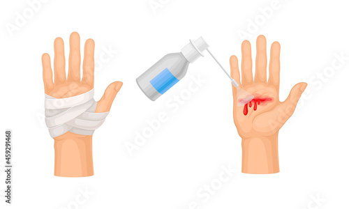 Skin burn injury treatment. First aid for thermal wound. Medicine for cure and bandaging vector illustration