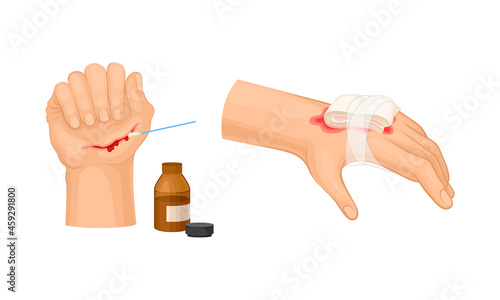 Skin burn injury treatment. Hurt human hand with first aid bandage vector illustration