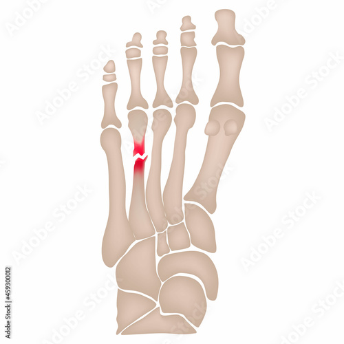 Fracture of the metatarsal bones in the foot. Anatomical structure of the foot. Skeleton. Broken bones. Vector illustration on isolated background photo