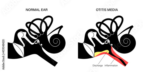 otitis media disease