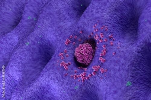 Early stage gastric cancer tumor on the stomach wall angle view 3d illustration