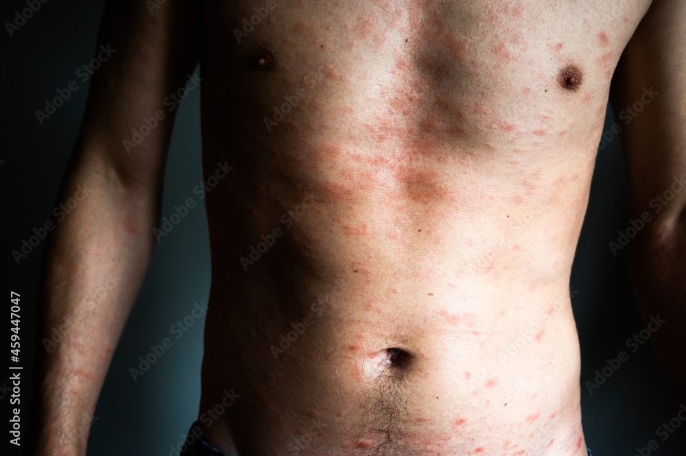 Skin imperfection. Naked man with skin allergy. Urticaria disease. Red spots on the skin. Close-up.