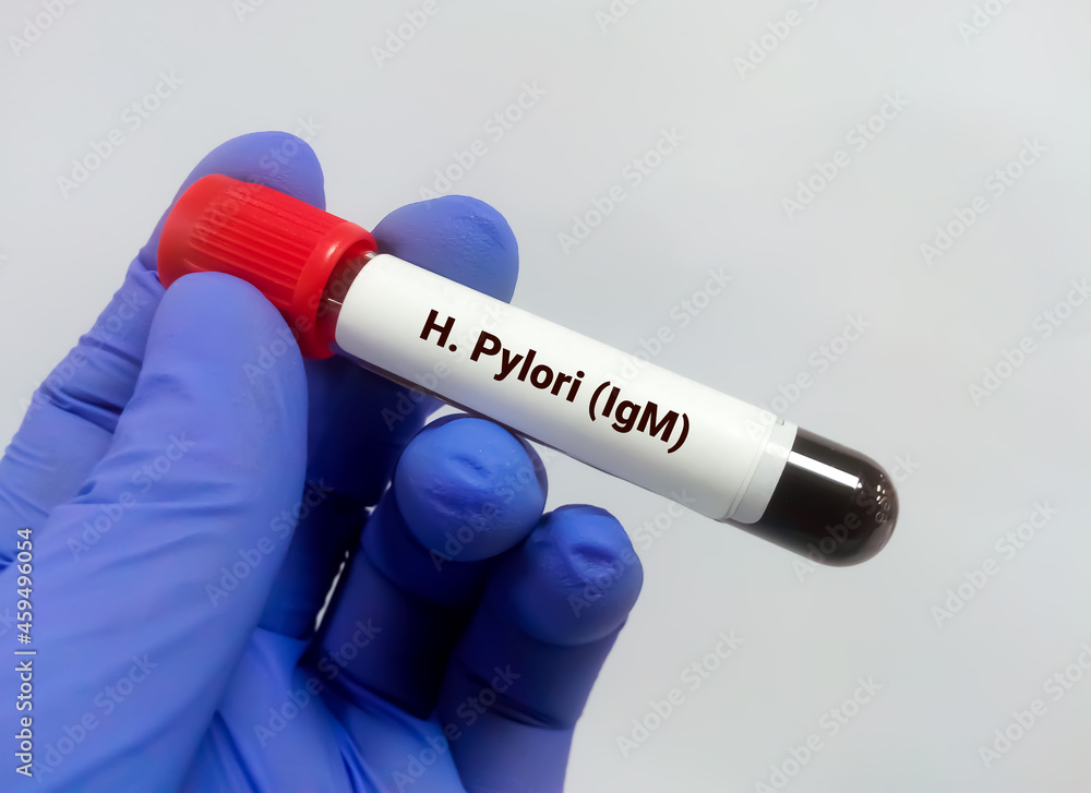 Blood sample for H. Pylori (IgM) test. Helicobacter pylori Stock Photo