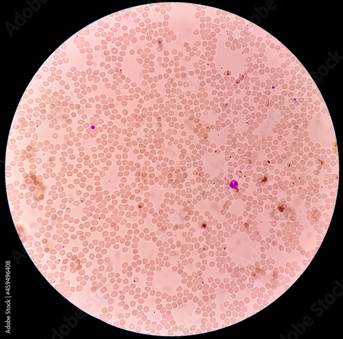 Microscopic view of hematological stained slide. thrombocytopenia photo