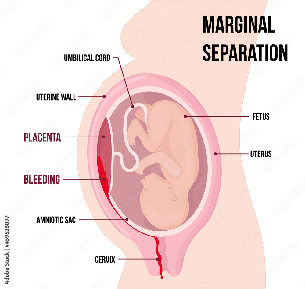 Fototapeta premium child in womb. Marginal separation of placenta, placental abruption. Vaginal bleeding. Dangerous complication of pregnancy, threat of miscarriage.