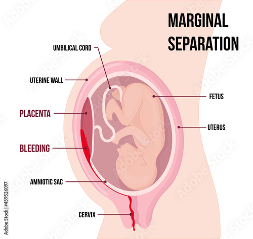 child in womb. Marginal separation of placenta, placental abruption. Vaginal bleeding. Dangerous complication of pregnancy, threat of miscarriage.