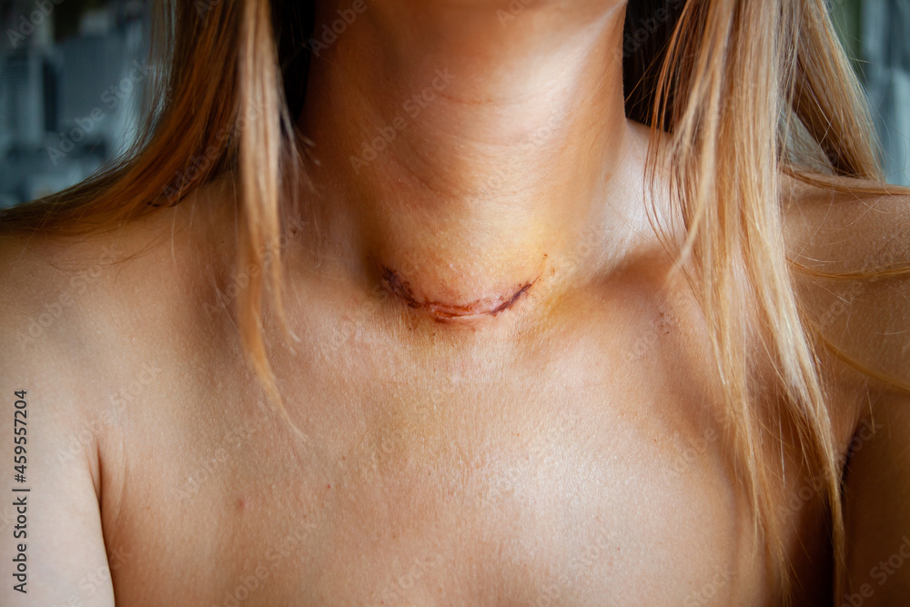healing of a scar and suture on the neck of a Caucasian woman after removal of the thyroid gland Hemithyroidectomy Thyroidectomy 5 days after surgery. Young scar on the body by surgery healing of a scar and suture on the neck of a Caucasian woman after removal of the thyroid gland Hemithyroidectomy Thyroidectomy 5 days after surgery. Young scar on the body by surgery