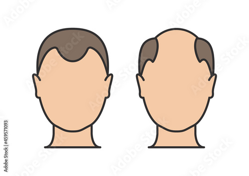 Hair loss man icon cartoon vector logo. Hair loss male scalp bald illustration