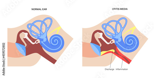 otitis media disease