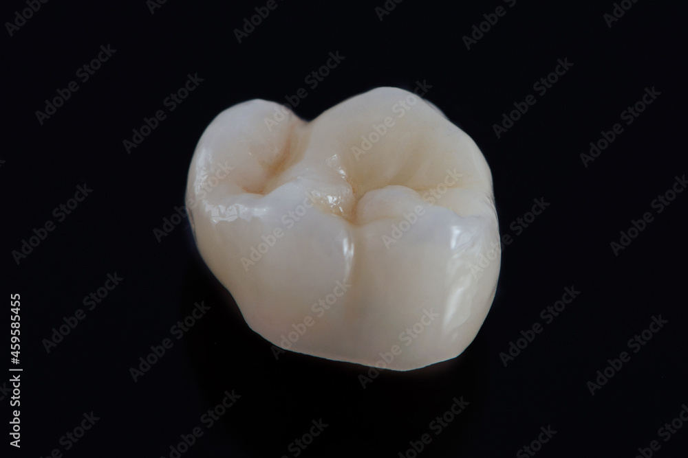 Dental crown of chewing tooth made of high quality ceramic on a black background. Dental crown of chewing tooth made of high quality ceramic on a black background.