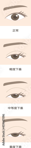 眼瞼下垂のイラスト
