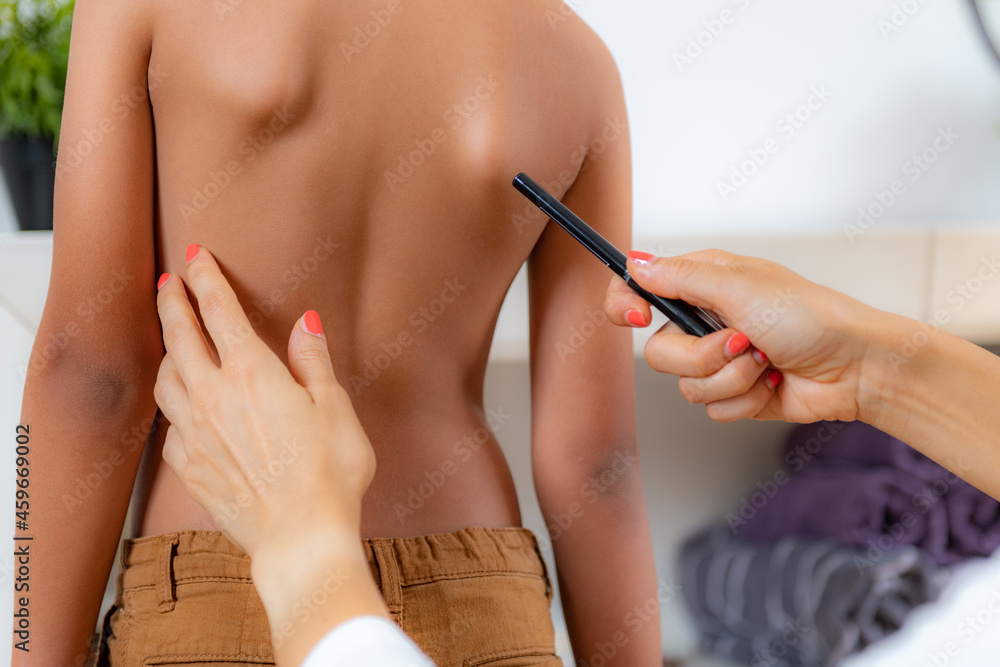 Pediatric doctor examining posture of a boy, making marks on his back, checking angle of scapula bones. - obrazy, fototapety, plakaty 