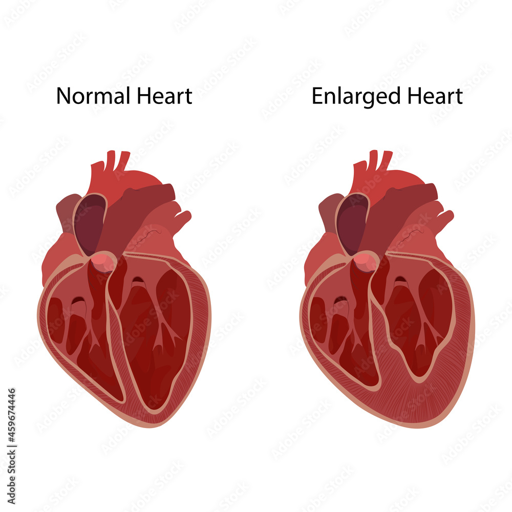 Normal and enlarged heart, cardiomegaly, inner inside view. Vector ...