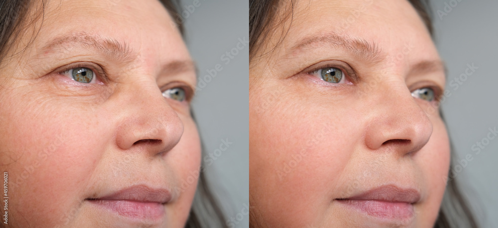 Obraz premium close-up of part of face of middle-aged woman in two versions, small wrinkles on skin, concept of anti-aging procedures, facial massage, before and after cosmetic procedures