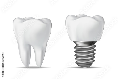 Human Tooth and Dental Implant, dental concept, realistic vector illustration