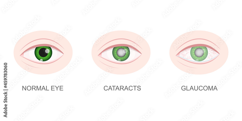 Healthy, cataract and glaucoma eye closeup view. Eyeball with normal and unhealthy lens. Aging visual problems concept. Anatomically detailed human organ of vision. Vector cartoon illustration. Healthy, cataract and glaucoma eye closeup view. Eyeball with normal and unhealthy lens. Aging visual problems concept. Anatomically detailed human organ of vision. Vector cartoon illustration.