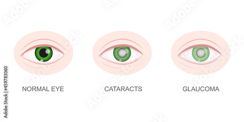 Healthy, cataract and glaucoma eye closeup view. Eyeball with normal and unhealthy lens. Aging visual problems concept. Anatomically detailed human organ of vision. Vector cartoon illustration. photo