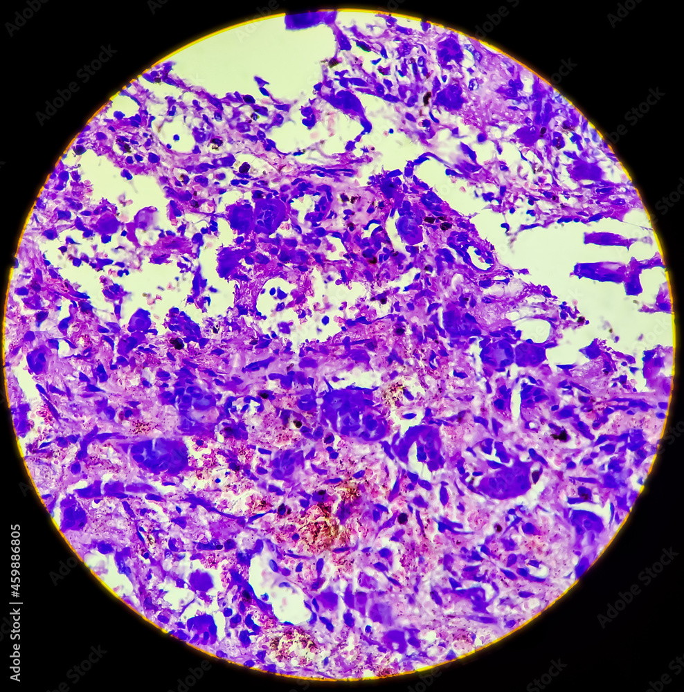 Osteoclast like giant cells. Light micrograph of a giant cell tumour of ...