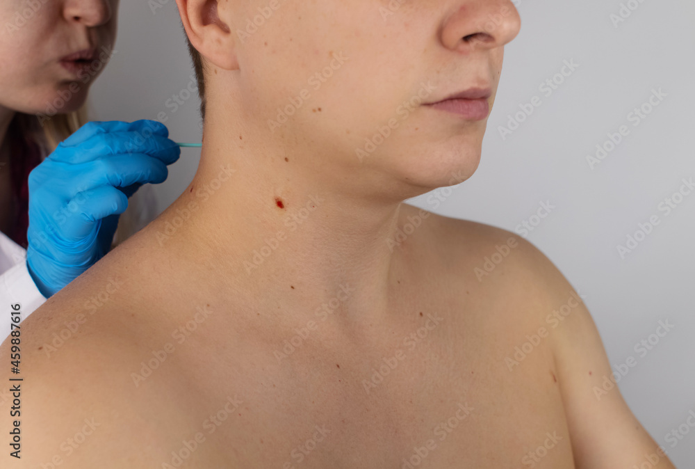 Close-up of the wound that remained after excision of the nevus. Removal and treatment of benign skin lesions. Surgery. Doctor and patient in one shot. Skin disease treatment and surgical care concept Close-up of the wound that remained after excision of the nevus. Removal and treatment of benign skin lesions. Surgery. Doctor and patient in one shot. Skin disease treatment and surgical care concept