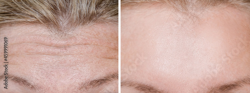 Forehead wrinkles on female face before and after treatment, rejuvenation and antiaging procedures at cosmetologist and dermatologist, plastic surgery