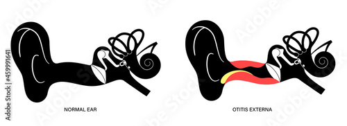 Swimmers ear otitis