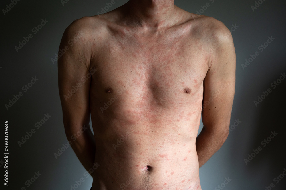 Body of adult man have spotted, red pimple and bubble rash from chickenpox or varicella zoster virus. Medical complications after illness.